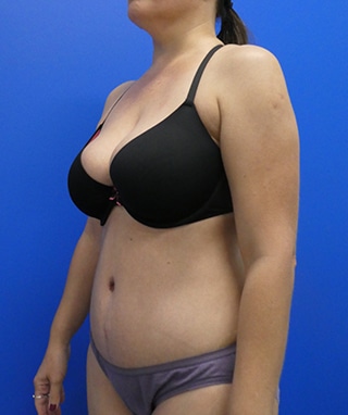Tummy Tuck after, case 1147, angle view
