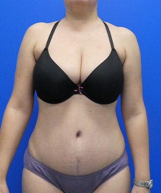 Tummy Tuck after, case 1147, front view