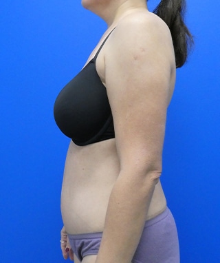 Tummy Tuck after, case 1147, side view