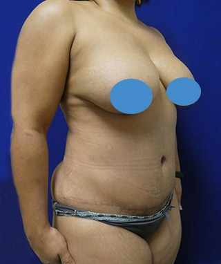 Tummy Tuck after, case 1145, angle view