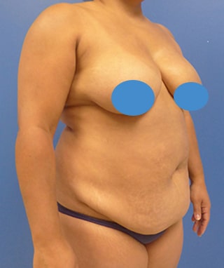 Tummy Tuck before, case 1145, angle view