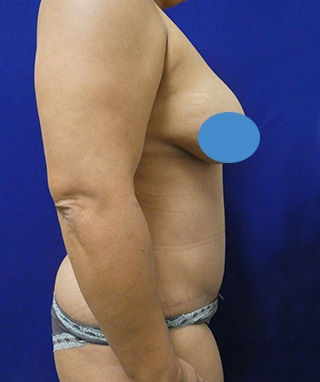 Tummy Tuck after, case 1145, side view