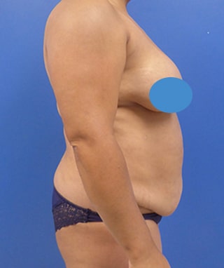 Tummy Tuck before, case 1145, side view