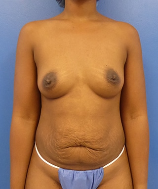 Tummy Tuck before, case 1143, front view