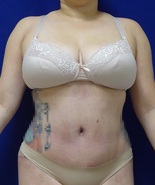 Tummy Tuck after, case 1138, front view