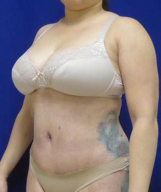 Tummy Tuck after, case 1138, oblique view