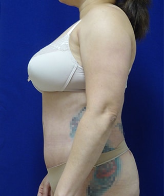 Tummy Tuck after, case 1138, side view