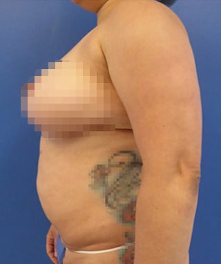 Tummy Tuck before, case 1138, side view