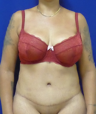 Tummy Tuck after, case 1137, front view