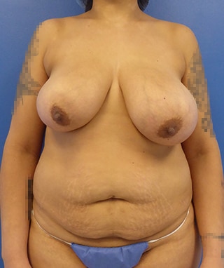 Tummy Tuck before, case 1137, front view