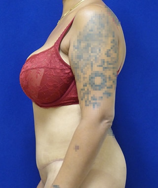Tummy Tuck before, case 1137, side view