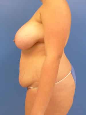 Tummy Tuck before, case 1133, side view