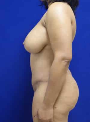 Tummy Tuck after, case 1131, side view
