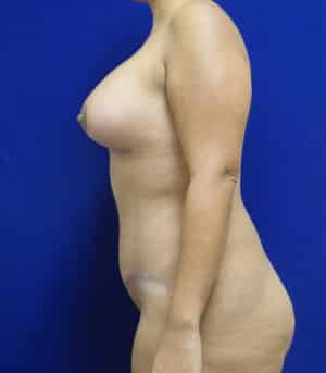 Tummy Tuck after, case 1130, side view
