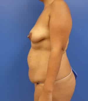 Tummy Tuck before, case 1130, side view
