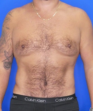 Tummy Tuck after, case 1156, front view