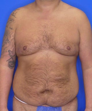 Tummy Tuck before, case 1156, front view