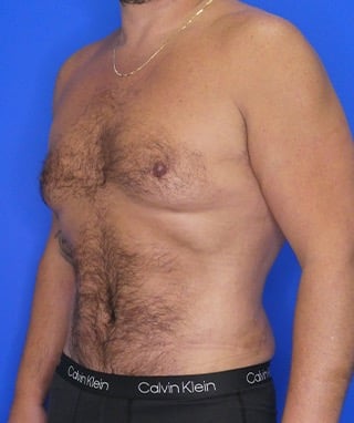 Tummy Tuck after, case 1156, oblique view