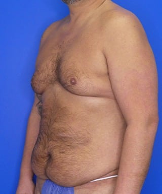 Tummy Tuck before, case 1156, oblique view
