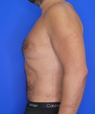 Tummy Tuck after, case 1156, side view