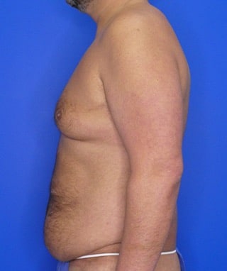 Tummy Tuck before, case 1156, side view