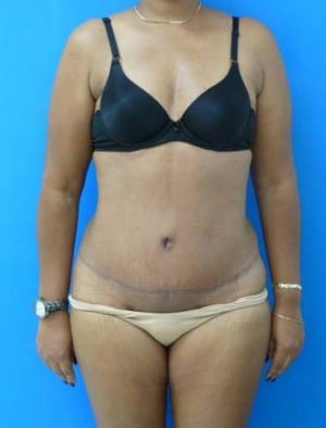 Tummy Tuck after, case 1128, front view