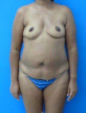 Tummy Tuck before, case 1128, front view