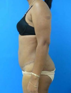 Tummy Tuck after, case 1128, side view