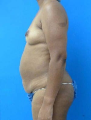 Tummy Tuck before, case 1128, side view