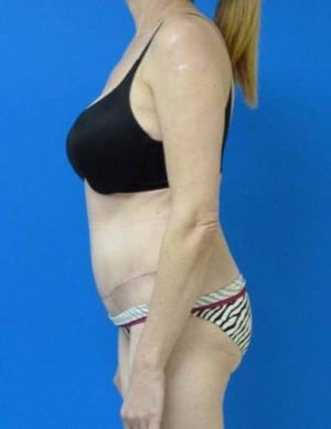 Tummy Tuck after, case 1127, side view