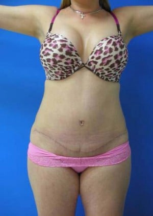 Tummy Tuck after, case 1126, front view