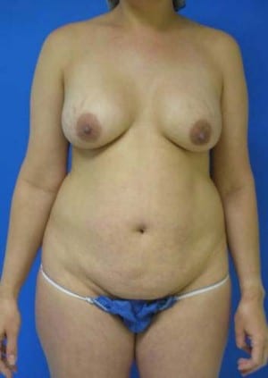 Tummy Tuck before, case 1126, front view