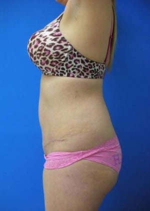 Tummy Tuck after, case 1126, side view