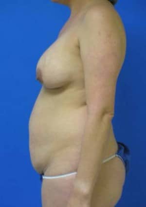 Tummy Tuck before, case 1126, side view