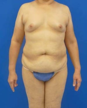 Tummy Tuck before, case 1125, front view