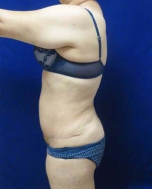 Tummy Tuck after, case 1125, side view