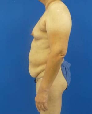 Tummy Tuck before, case 1125, side view