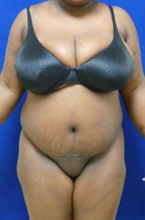 Tummy Tuck after, case 1124, front view