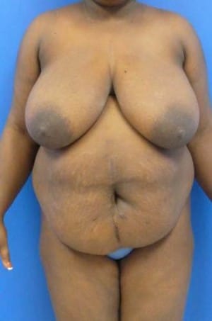 Tummy Tuck before, case 1124, front view