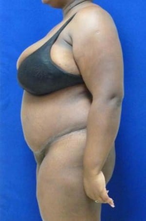 Tummy Tuck after, case 1124, side view