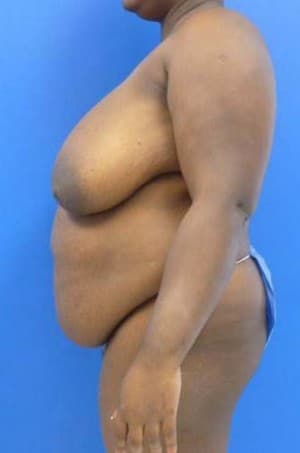Tummy Tuck before, case 1124, side view