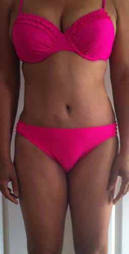 Tummy Tuck after, case 1123, front view