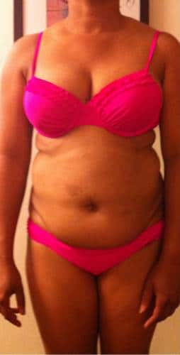 Tummy Tuck before, case 1123, front view