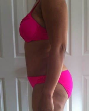 Tummy Tuck after, case 1123, side view