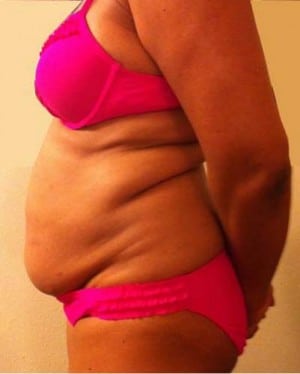 Tummy Tuck before, case 1123, side view