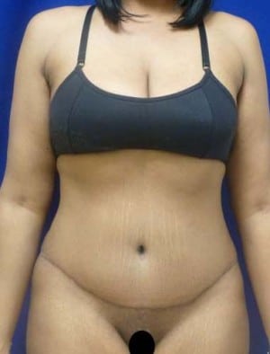 Tummy Tuck after, case 1121, front view