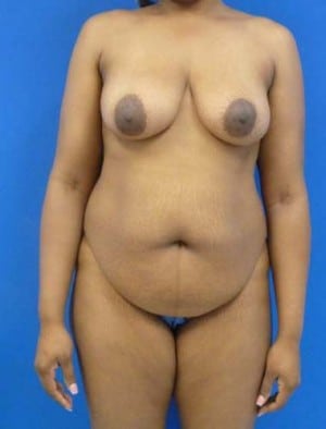 Tummy Tuck before, case 1121, front view