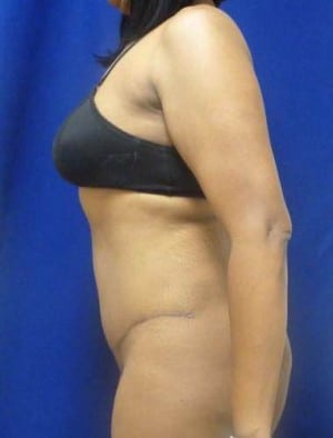 Tummy Tuck after, case 1121, side view