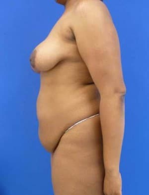 Tummy Tuck before, case 1121, side view