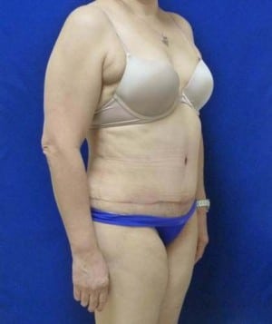Tummy Tuck after, case 1122, angle view